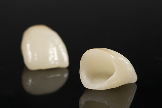 烤瓷牙也就是内里为金属的"小帽子",制作过程是将牙齿磨小后取印模